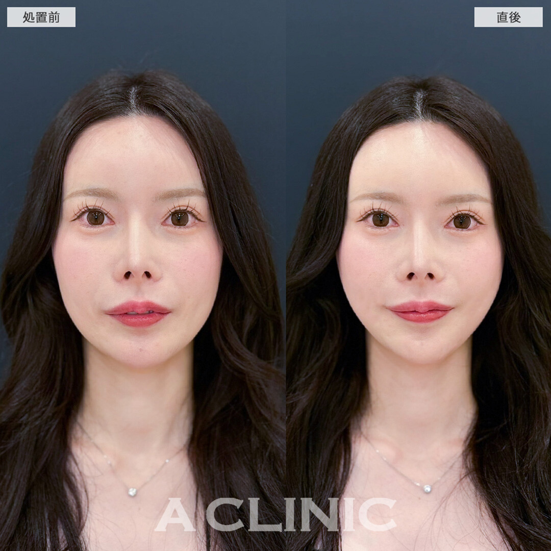 Aスレッドで下顔面の重心がUP！こちら処置前と直後の症例です(20代女性)