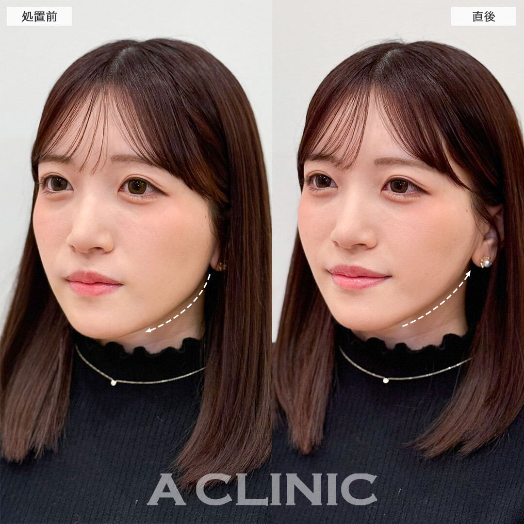 Aスレッドで頬のもたつきを解消し自然なリフトアップに成功！こちら処置前と直後の症例です(20代女性)