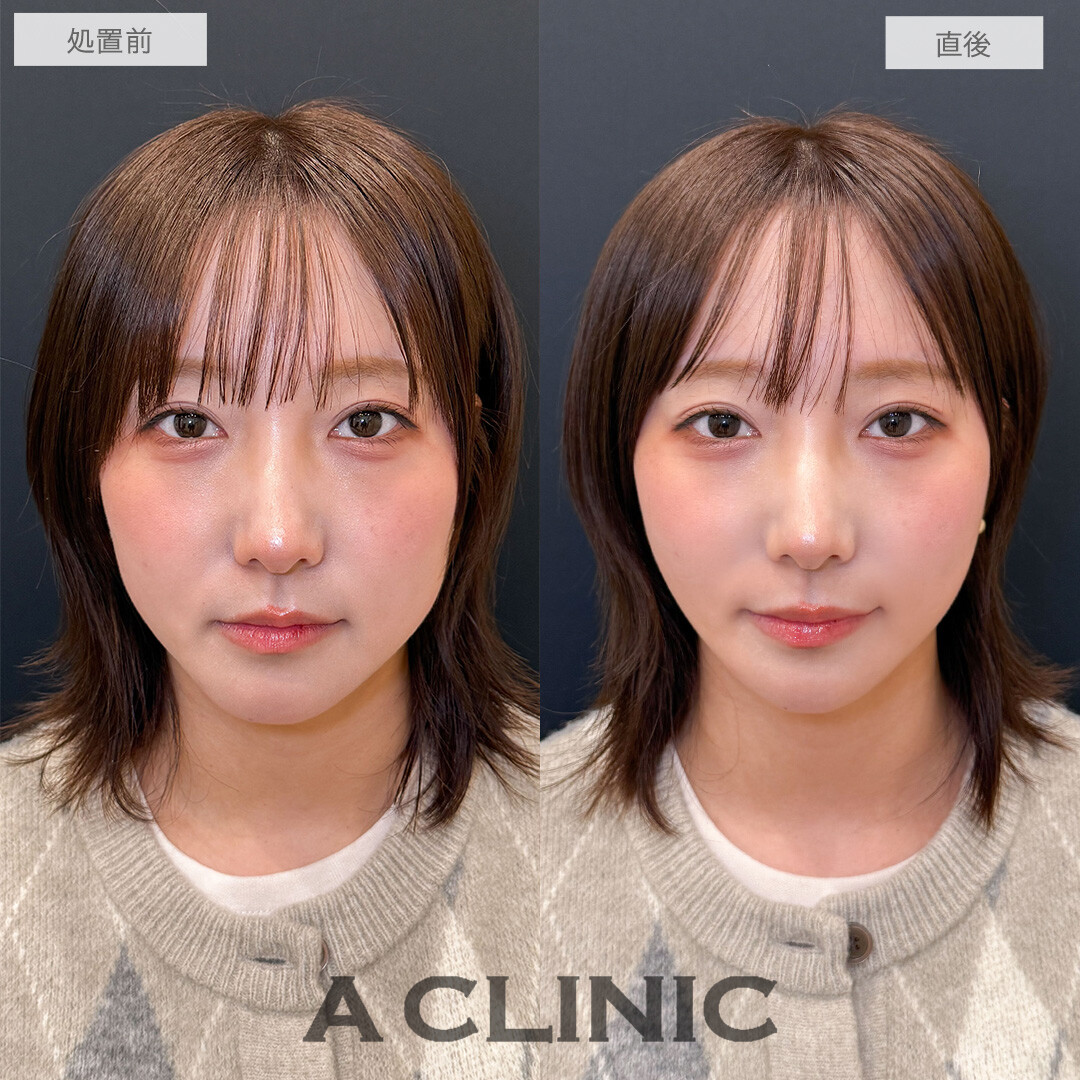 Aスレッドでお悩みだった左右差改善しました！こちら処置前と直後の症例です(30代女性)