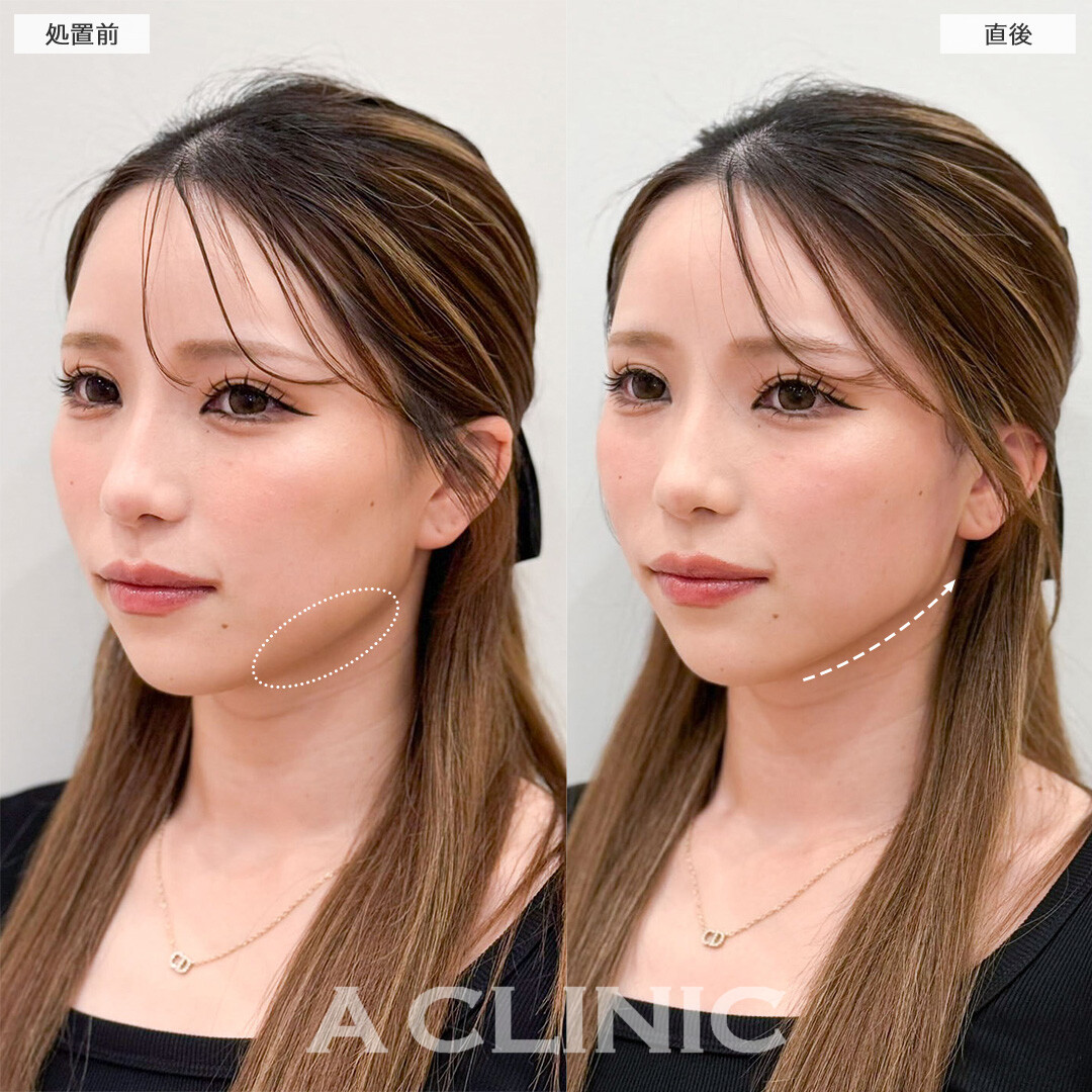 Aスレッドでもたつき改善し直後から垢抜け成功！こちら処置前と直後の症例です(20代女性)