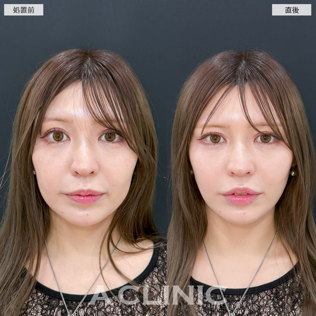 Aスレッドで切らずに手軽にリフトアップを実感！処置前と直後の症例です(30代女性)