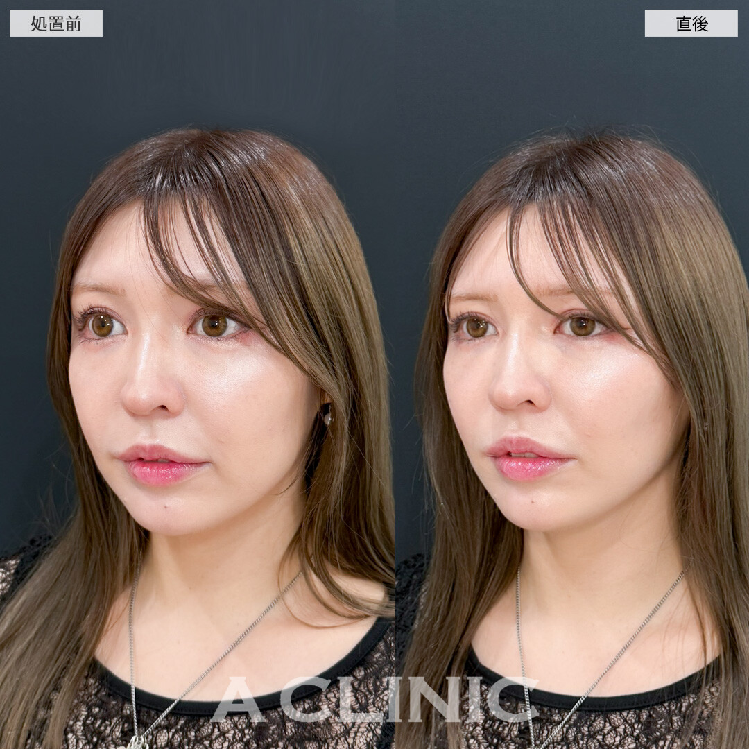 Aスレッドで切らずに手軽にリフトアップを実感！処置前と直後の症例です(30代女性)