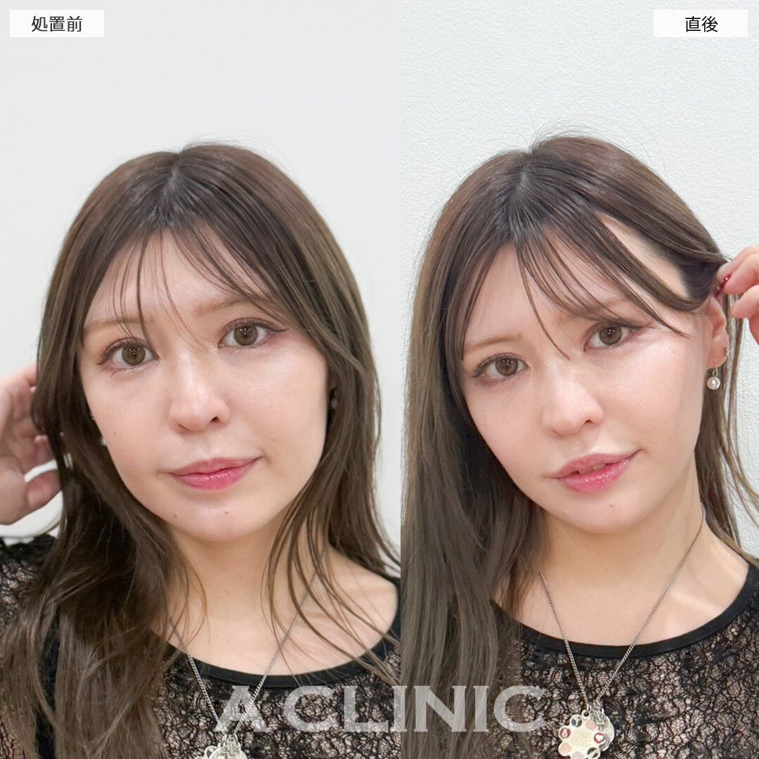 Aスレッドで切らずに手軽にリフトアップを実感！処置前と直後の症例です(30代女性)