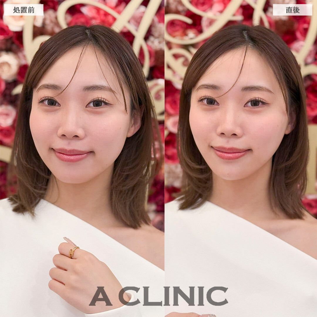 Aスレッドとあごへのヒアルロン酸注入の併用でどこから見ても美しいフェイスラインに！処置前と直後の症例です(20代女性)