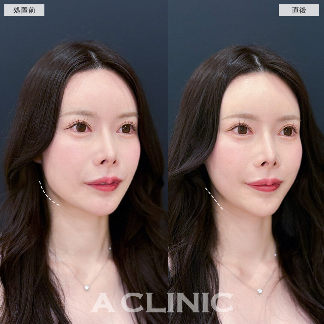 Aスレッドで下顔面の重心がUP！こちら処置前と直後の症例です(20代女性)