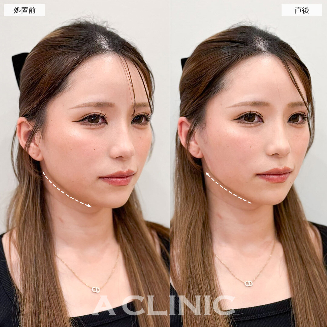 Aスレッドでもたつき改善し直後から垢抜け成功！こちら処置前と直後の症例です(20代女性)