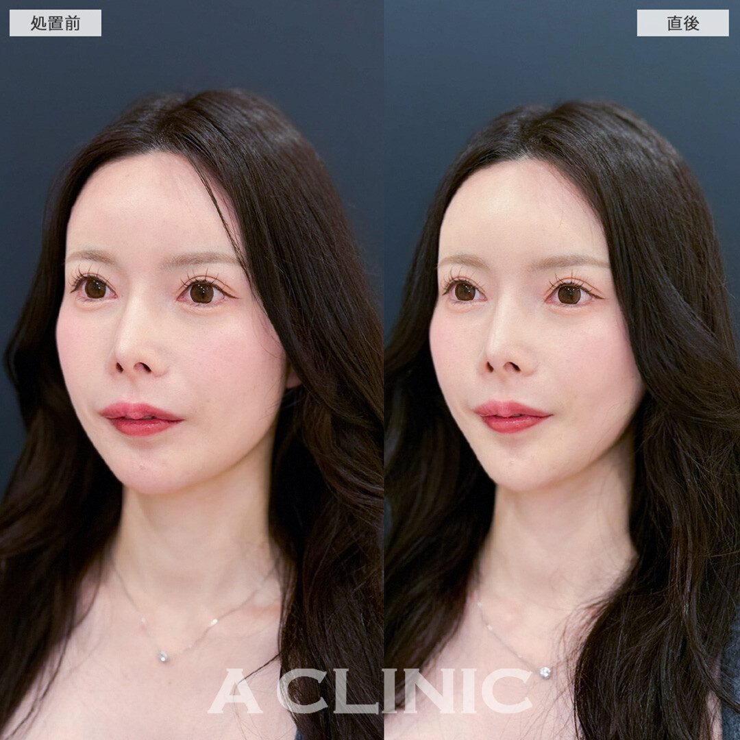 Aスレッドで下顔面の重心がUP！こちら処置前と直後の症例です(20代女性)