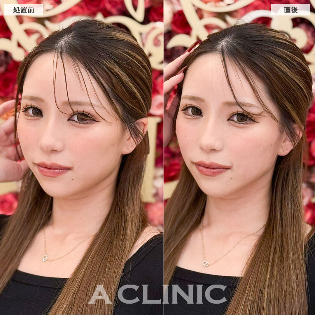 Aスレッドでもたつき改善し直後から垢抜け成功！こちら処置前と直後の症例です(20代女性)