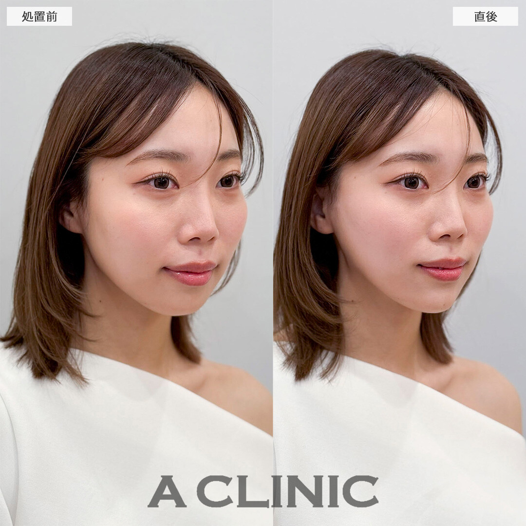 Aスレッドとあごへのヒアルロン酸注入の併用でどこから見ても美しいフェイスラインに！処置前と直後の症例です(20代女性)