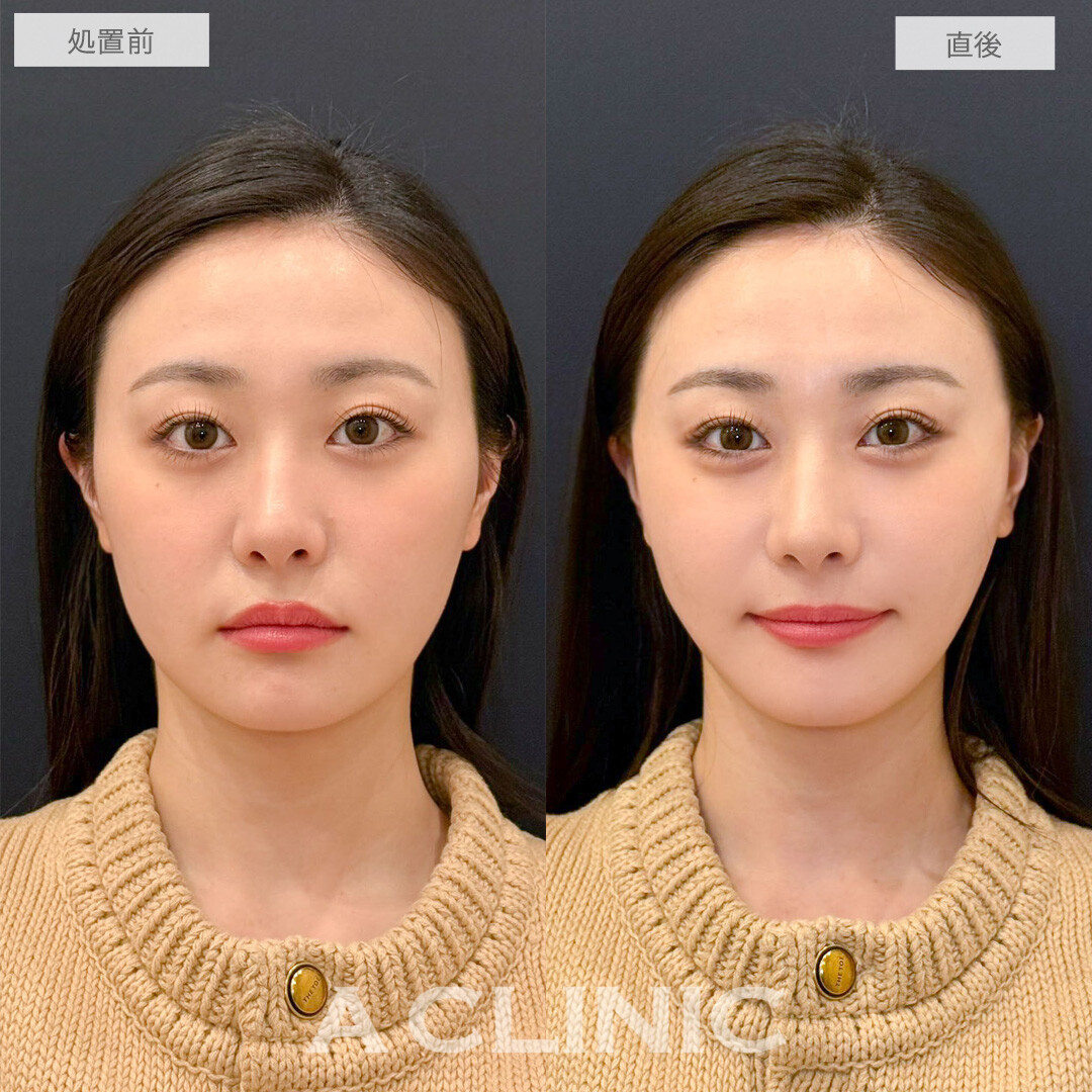 Aスレッドでずっと悩んでいた口横のもたつき卒業できました！こちら処置前と直後の症例です(20代女性)