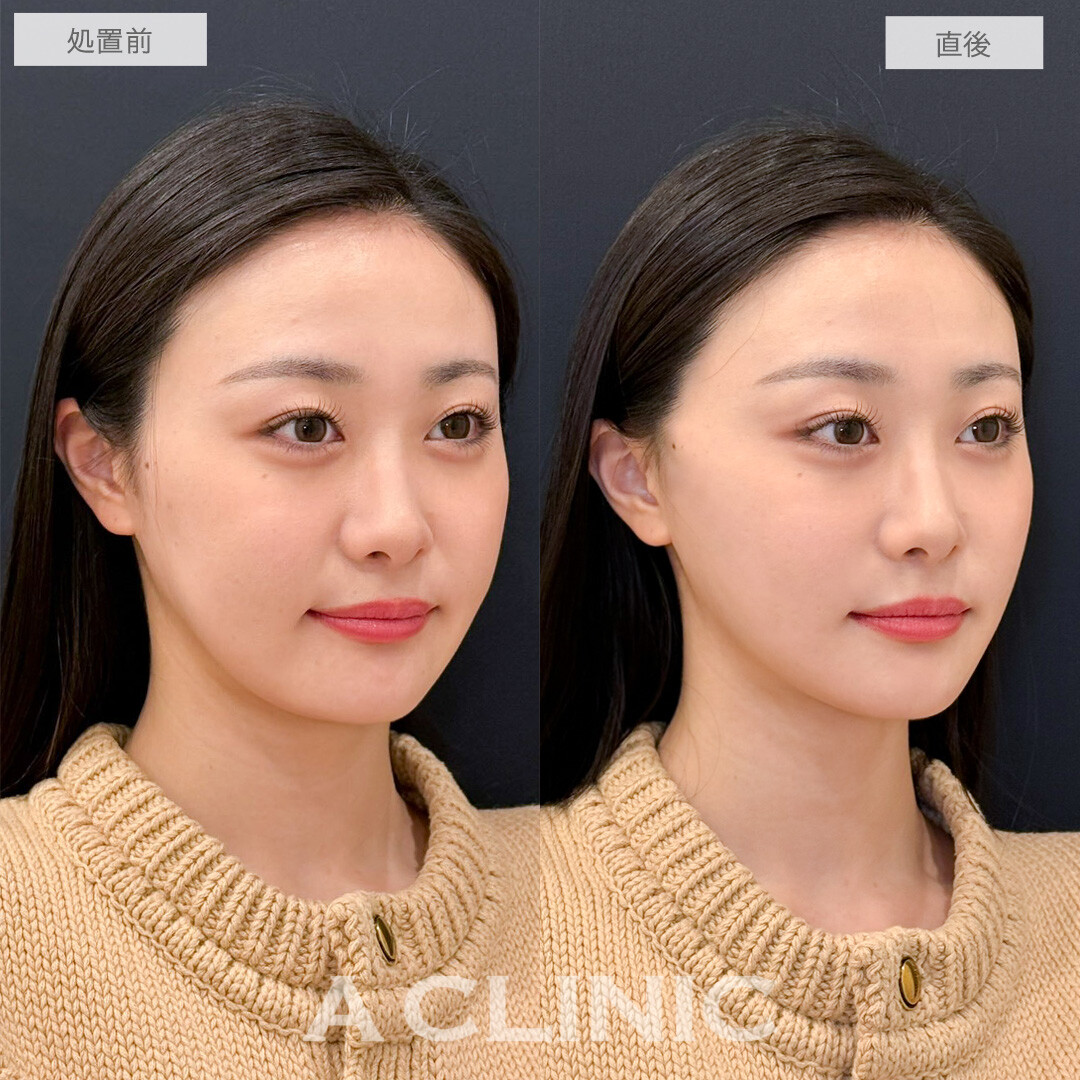 Aスレッドでずっと悩んでいた口横のもたつき卒業できました！こちら処置前と直後の症例です(20代女性)