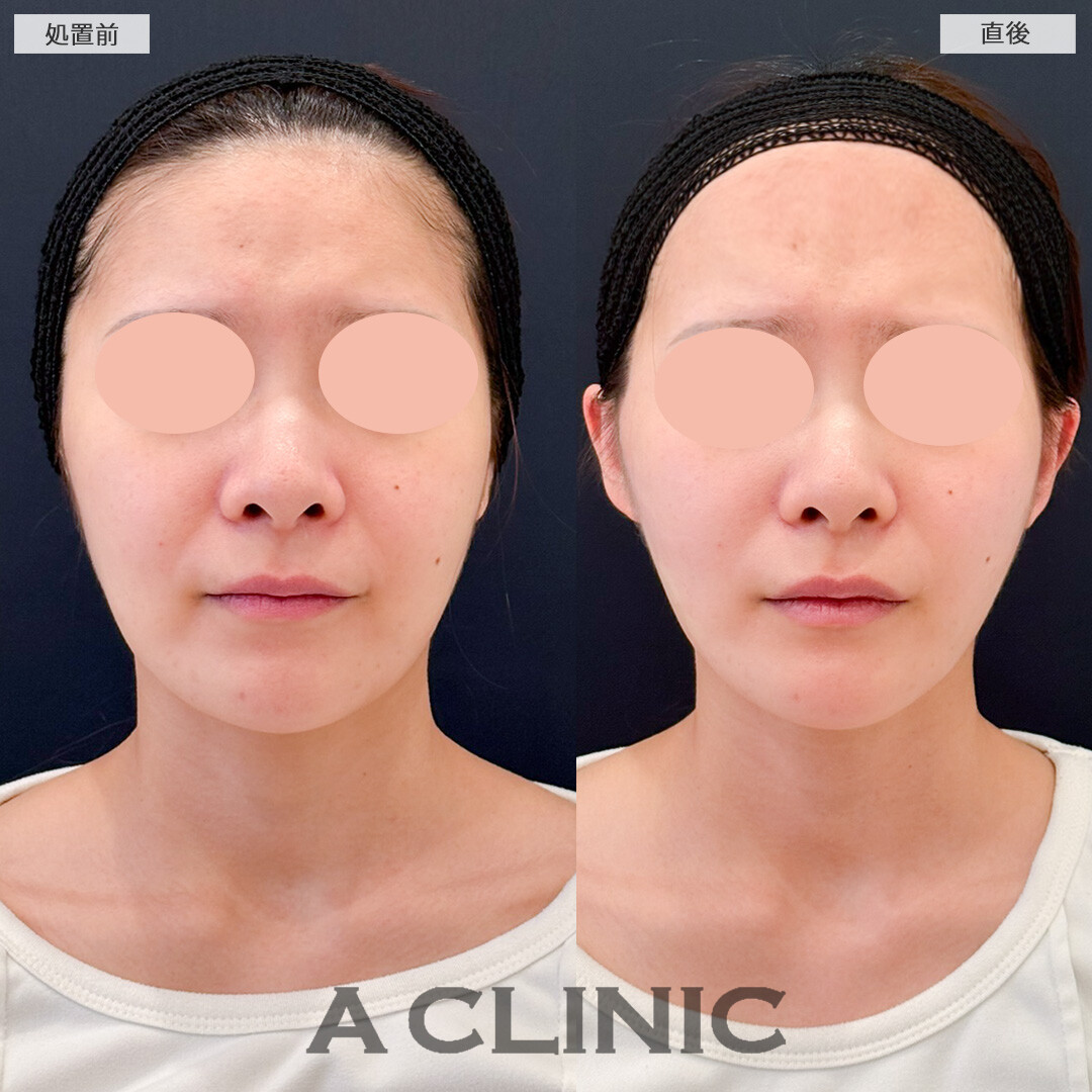 Aスレッドでここまで輪郭をスッキリ見せることができました！処置前と直後の症例です(20代女性)