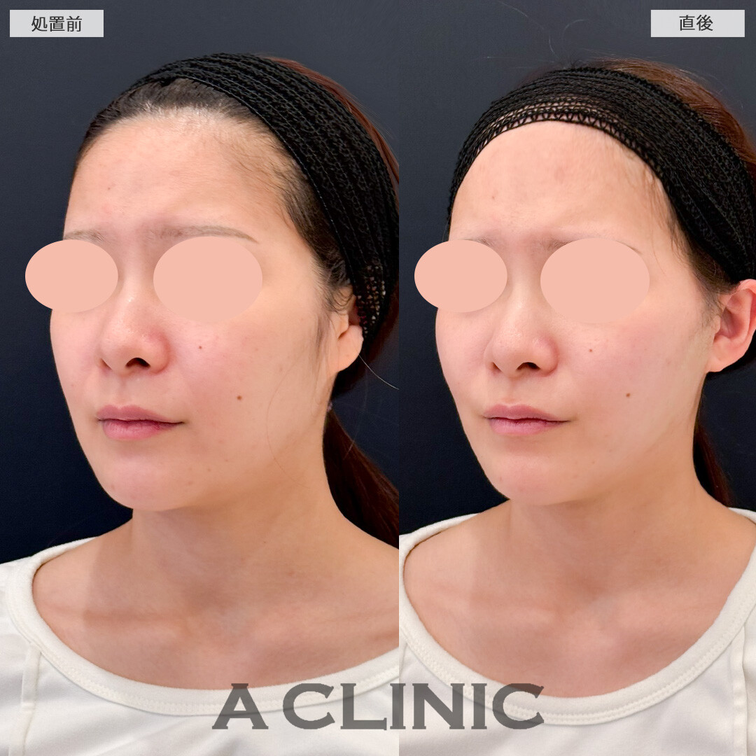 Aスレッドでここまで輪郭をスッキリ見せることができました！処置前と直後の症例です(20代女性)
