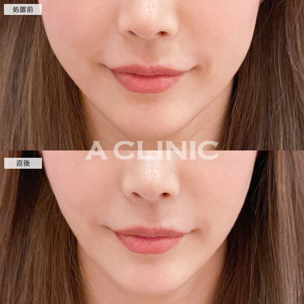 Aスレッドでフェイスラインの凹凸を整えます！こちら処置前と直後の症例です(40代女性)