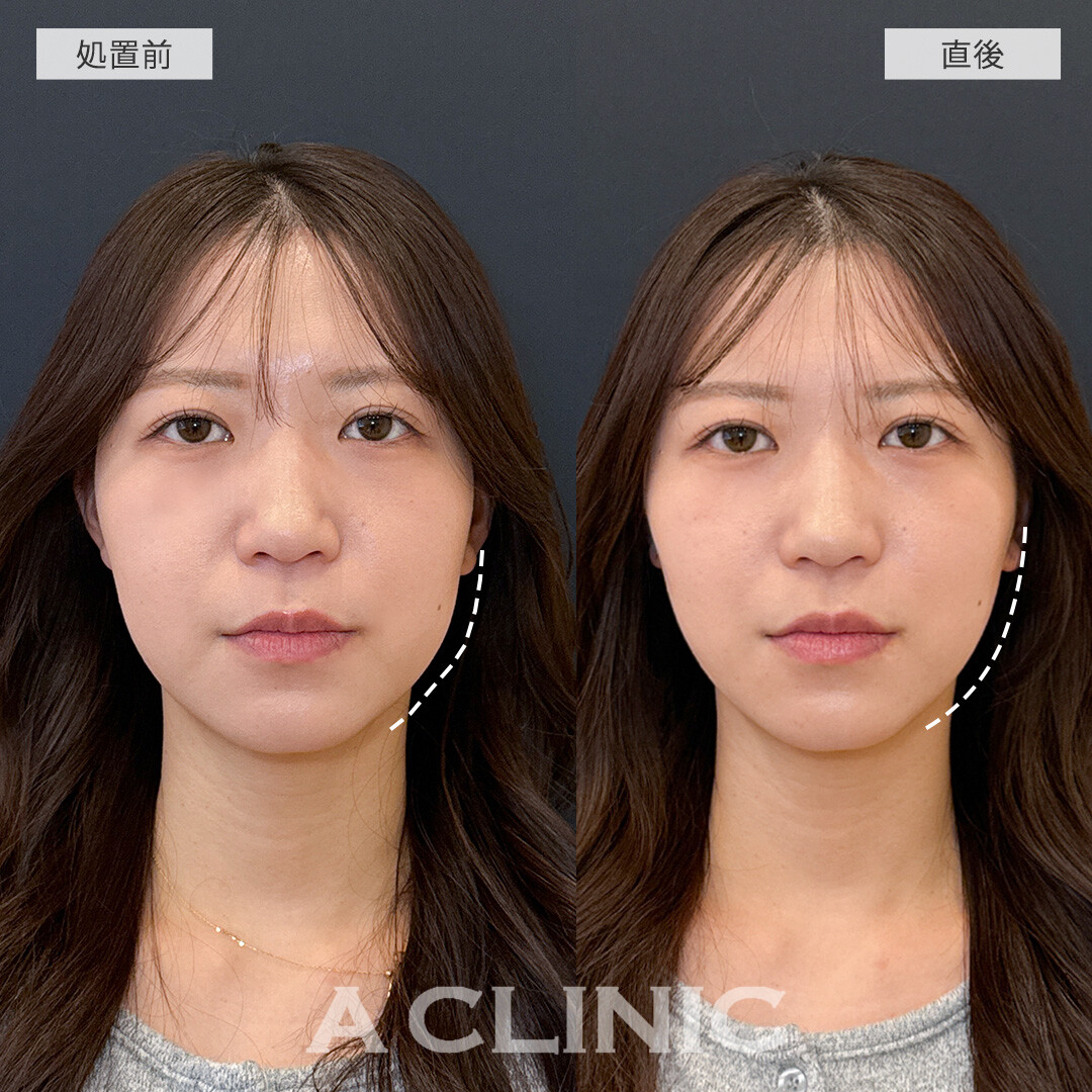 Aスレッドでお顔のもたつき解消！処置前と直後の症例です(20代女性)