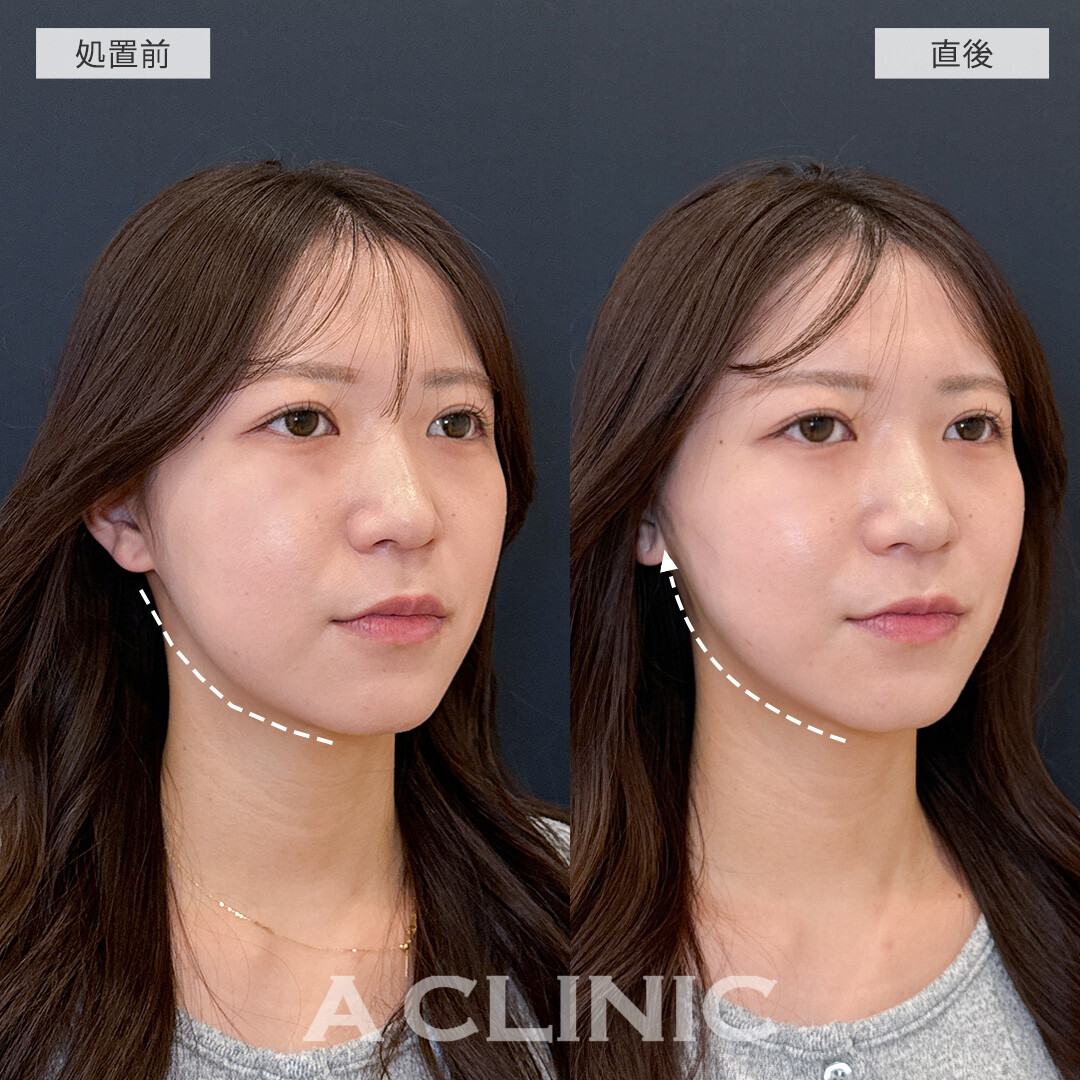Aスレッドでお顔のもたつき解消！処置前と直後の症例です(20代女性)