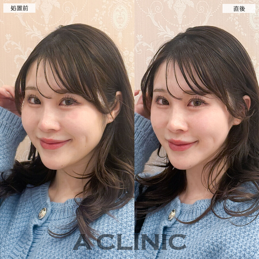 Aスレッドで丸顔改善！こちら処置前と直後の症例です(20代女性)