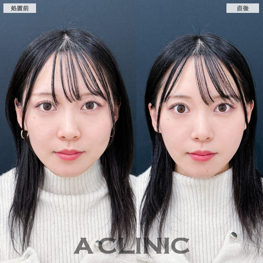 Aスレッドで膨らみのあった輪郭が滑らかになりました！こちら処置前と直後の症例です(20代女性)