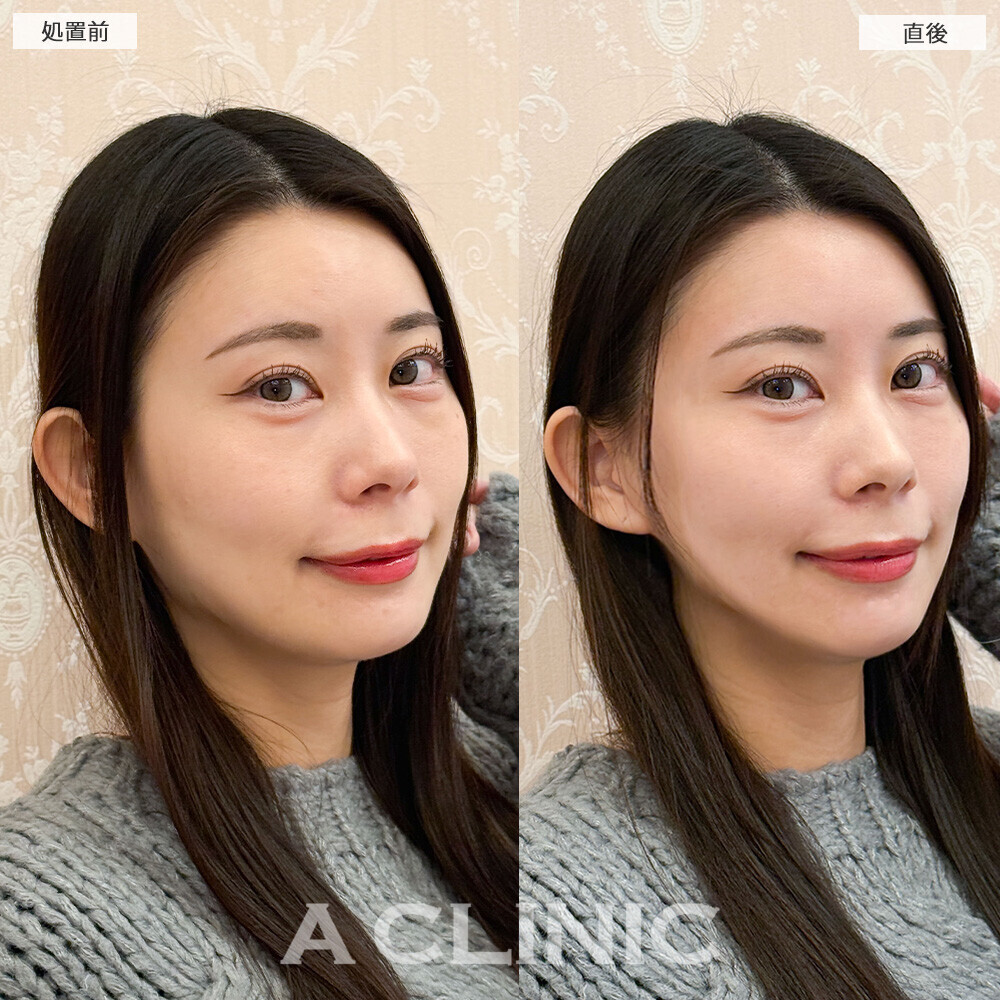 Aスレッドでもたつき解消！こちら処置前と直後の症例です(30代女性)