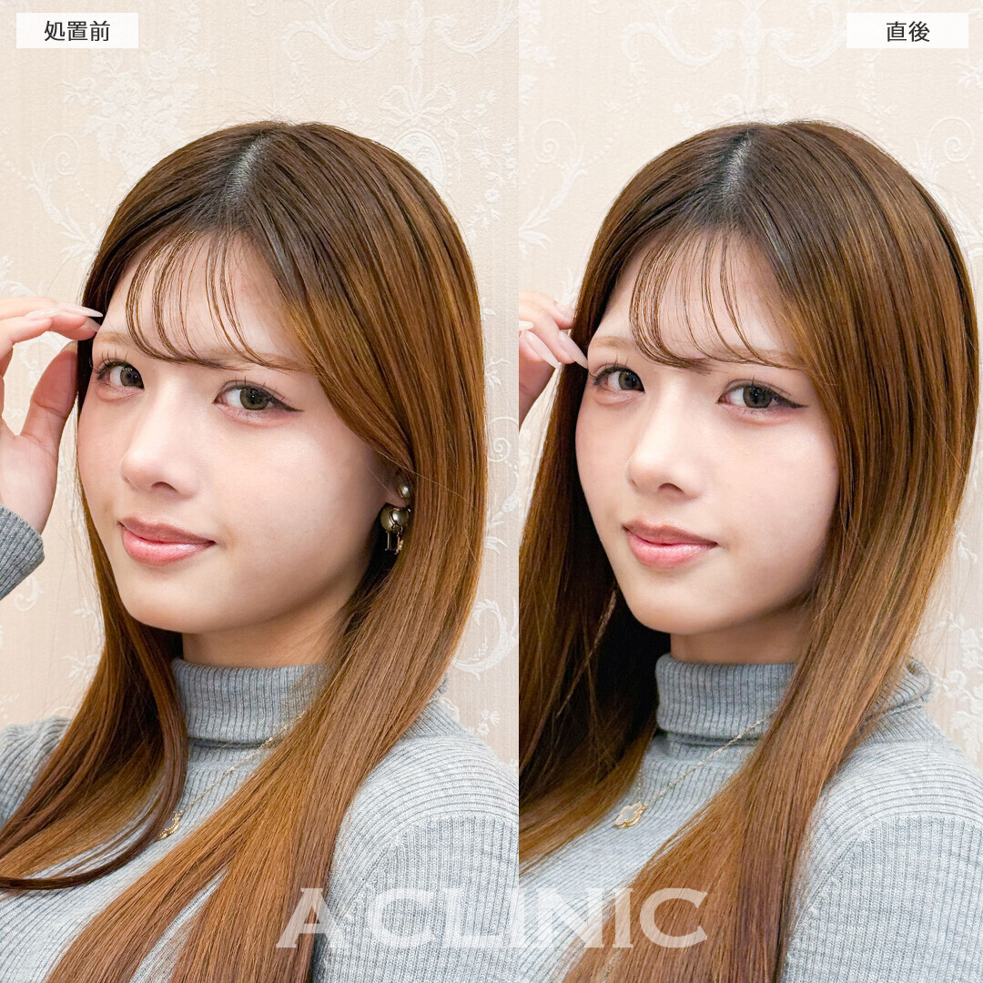 Aスレッドなら即日憧れのVフェイスに！こちら処置前と直後の症例です(10代女性)