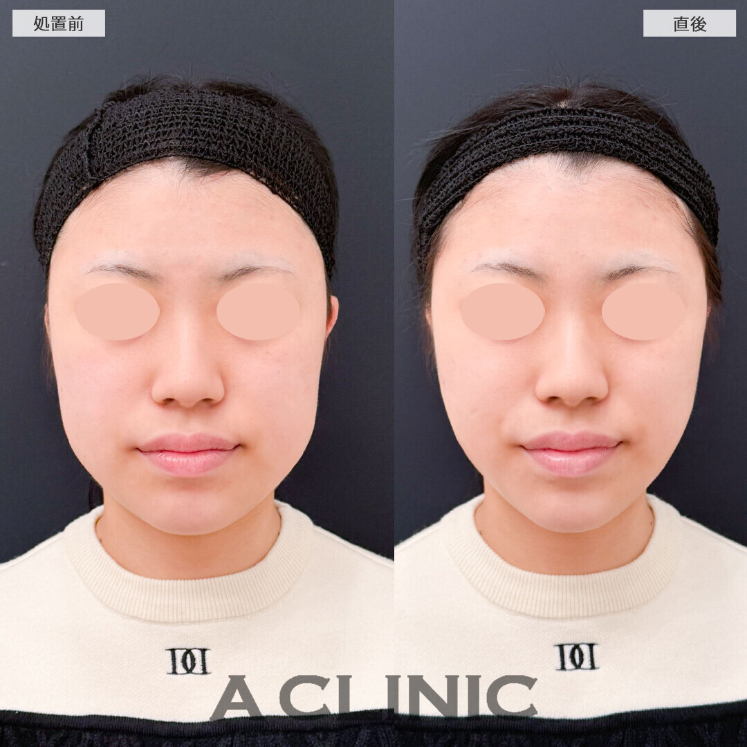 Aスレッドでスリムな印象の輪郭に！こちら処置前と直後の症例です(20代女性)