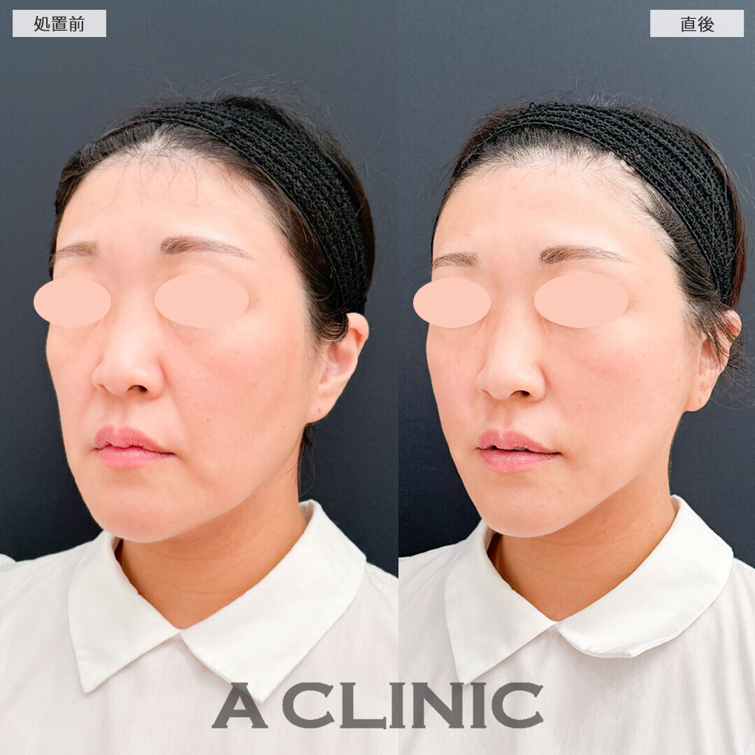 Aスレッドでフェイスライン全体のたるみが改善！こちら処置前と直後の症例です(40代女性)