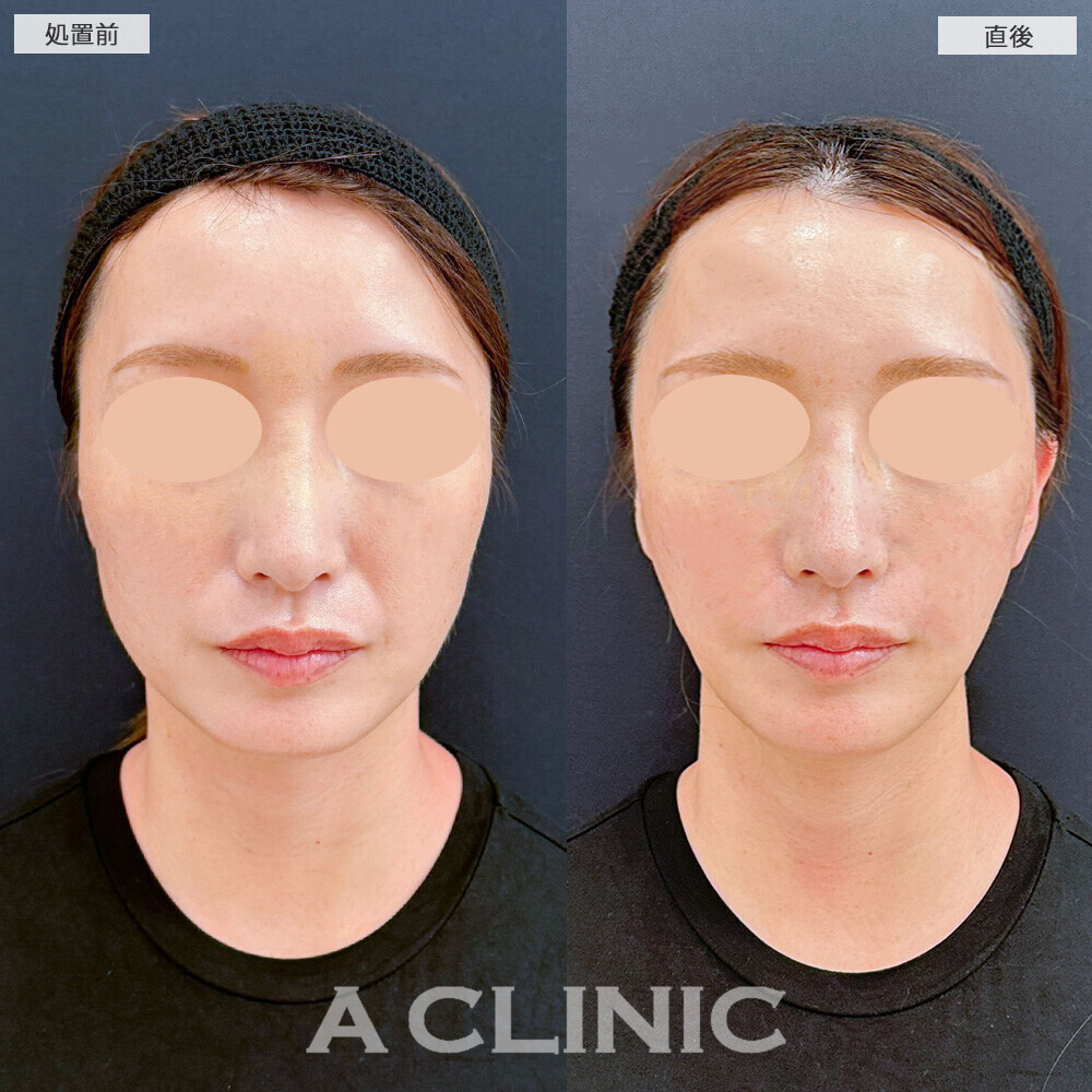 Aスレッドとヒアルロン酸注射(シワ)で若返りました！こちら処置前と直後の症例です(40代女性)