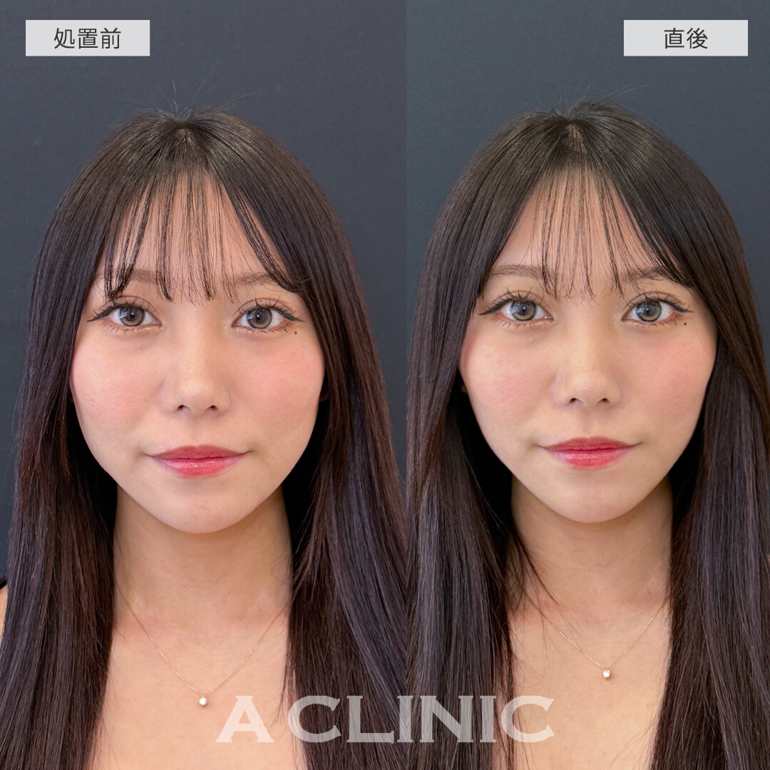 Aスレッドでもたつきを解消して直後からシュッとした輪郭に！こちら処置前と直後の症例です(20代女性)
