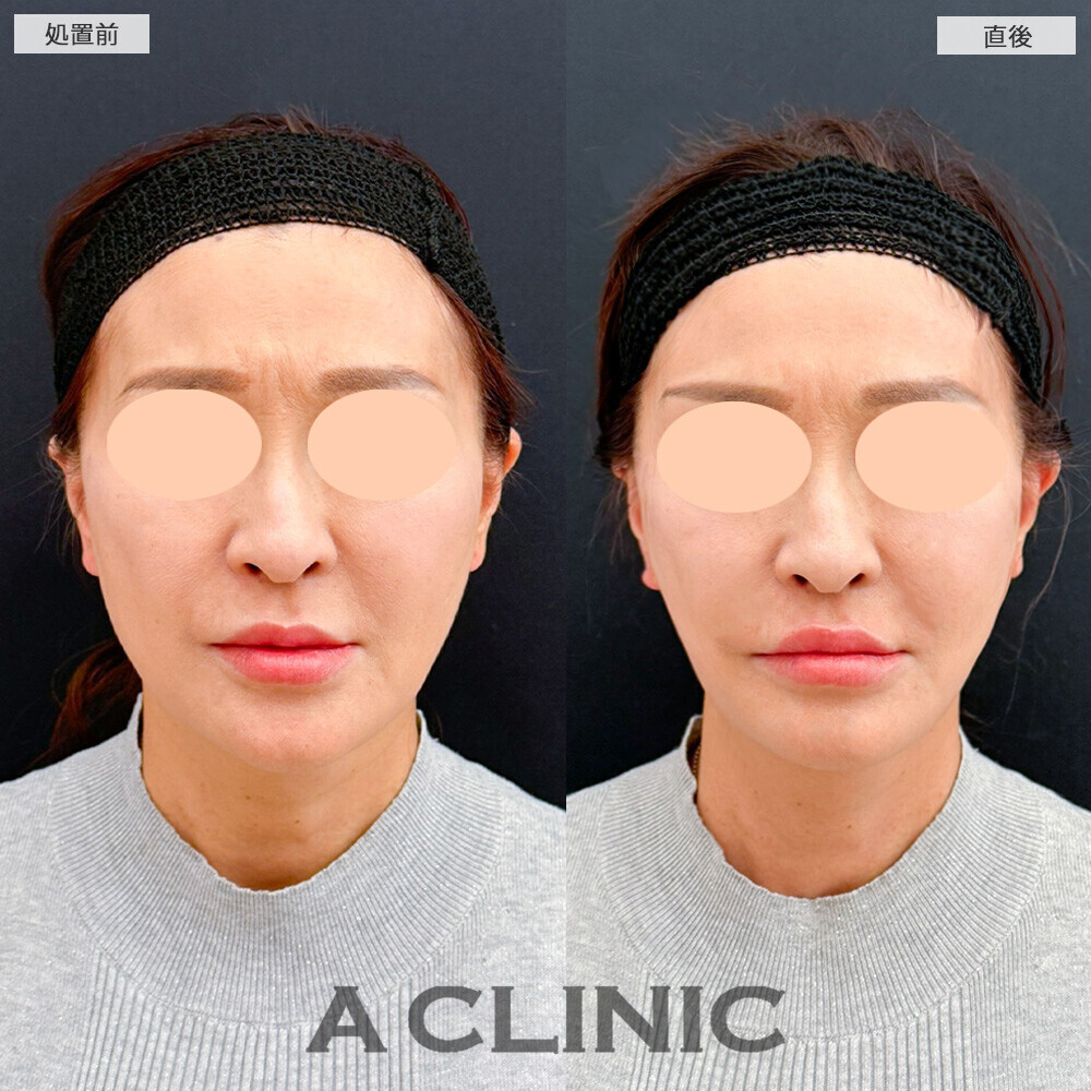 Aスレッドでたるみが引き上がりました！こちら処置前と直後の症例です(50代女性)