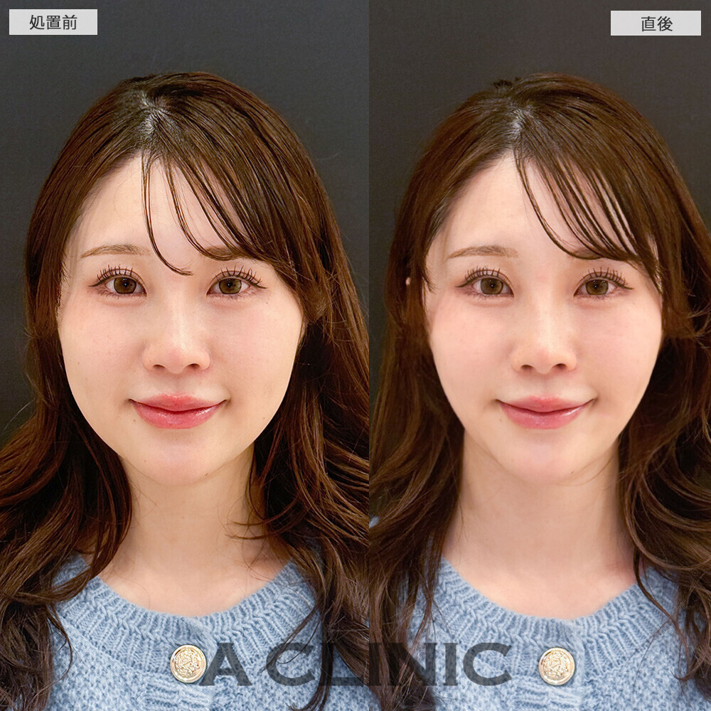 Aスレッドで丸顔改善！こちら処置前と直後の症例です(20代女性)