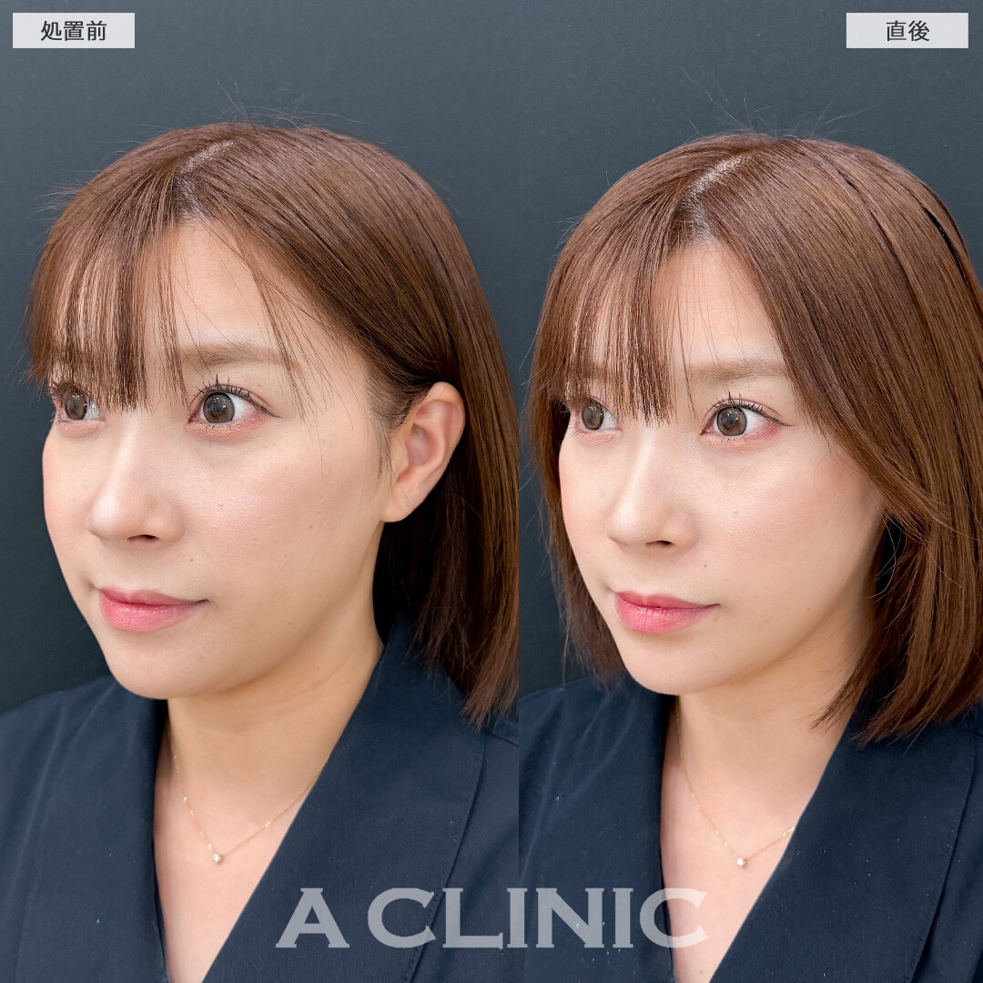 Aスレッドはお顔の左右差もなくすことができます！こちら処置前と直後の症例です(30代女性)