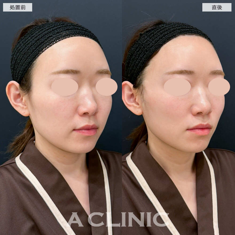 Aスレッドで口横のもたつきが改善し、フェイスラインがスッキリしました。処置前と直後の症例です(30代女性)