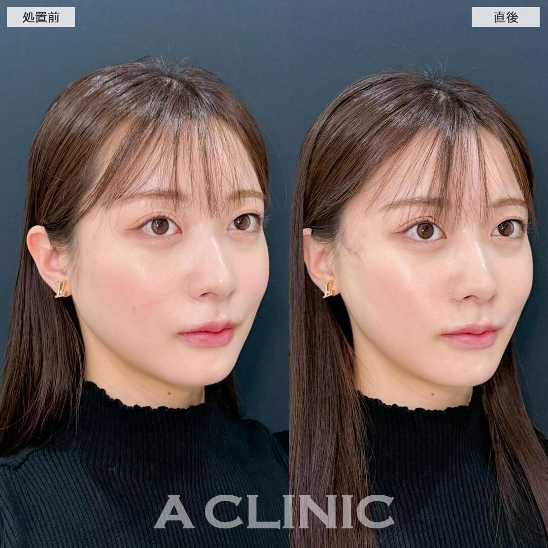 Aスレッドで左右差ともたつきを解消！こちら処置前と直後の症例です(20代女性)