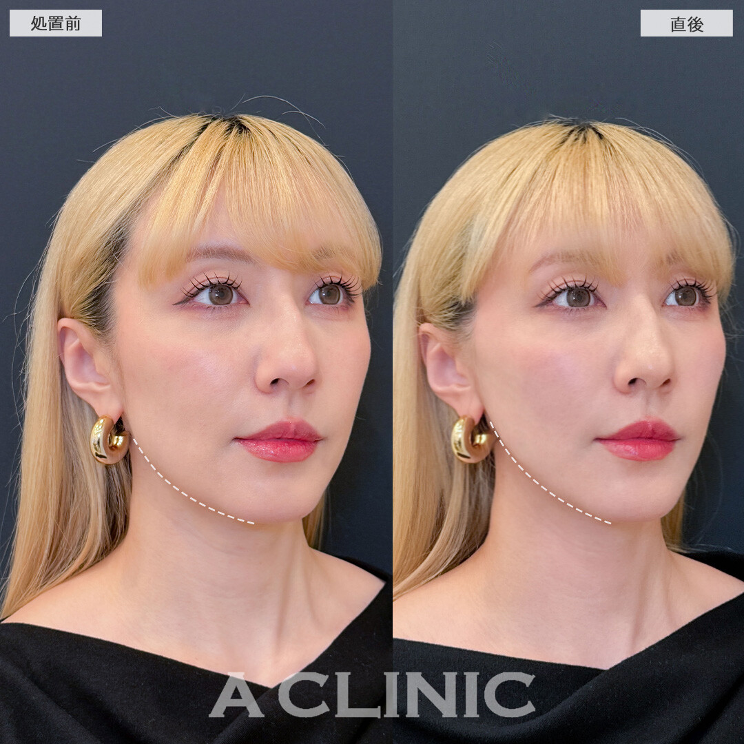 Aスレッドで直後から気になるたるみが無くなりシュッとした輪郭になりました！こちら処置前と直後の症例です(30代女性)