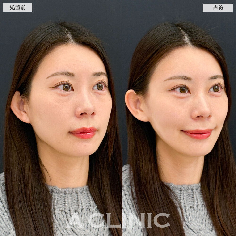 Aスレッドでもたつき解消！こちら処置前と直後の症例です(30代女性)