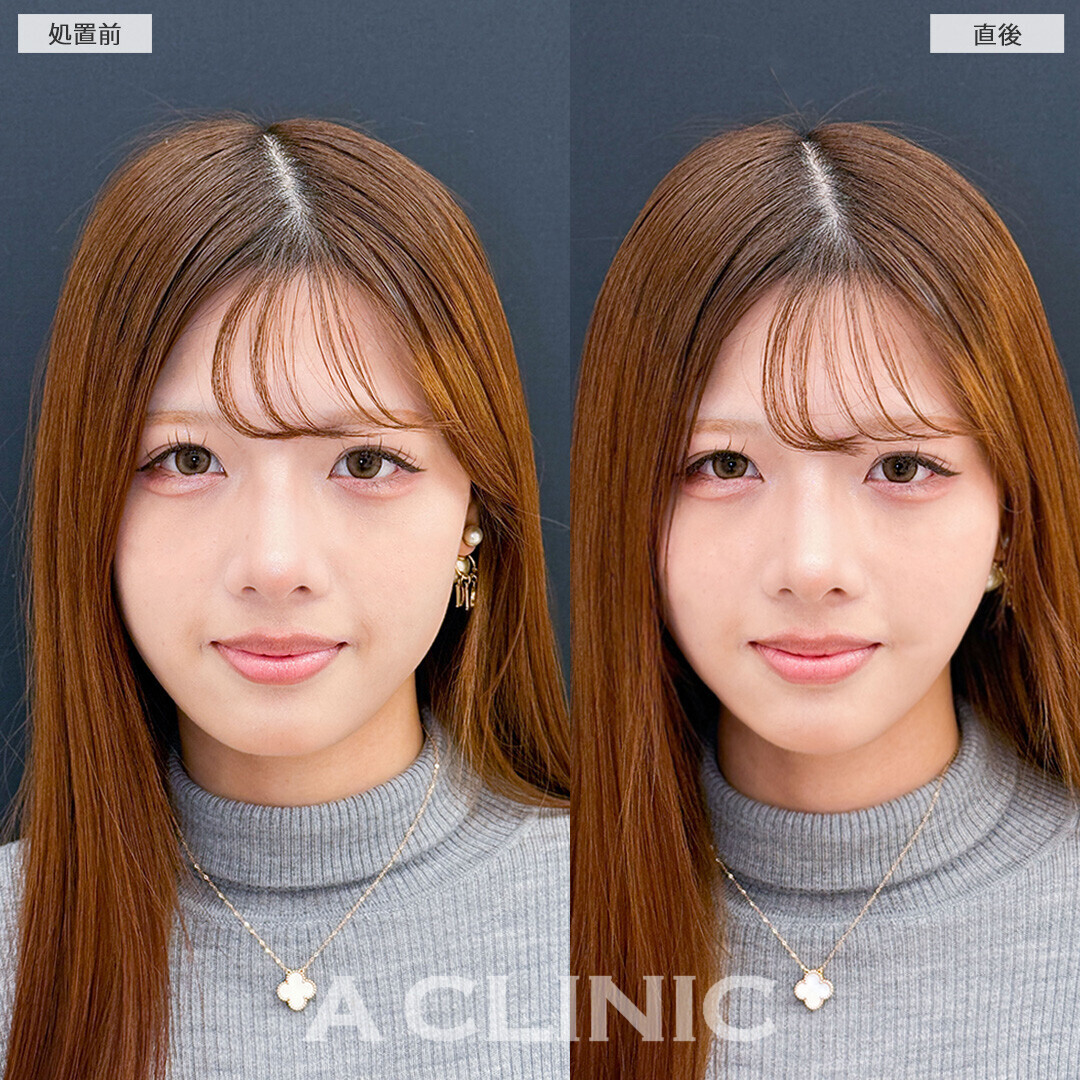 Aスレッドなら即日憧れのVフェイスに！こちら処置前と直後の症例です(10代女性)