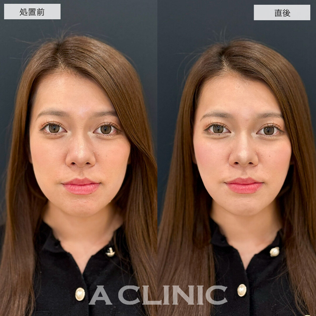 Aスレッドで理想の逆三角形の輪郭に!こちら処置前と直後の症例です(20代女性)