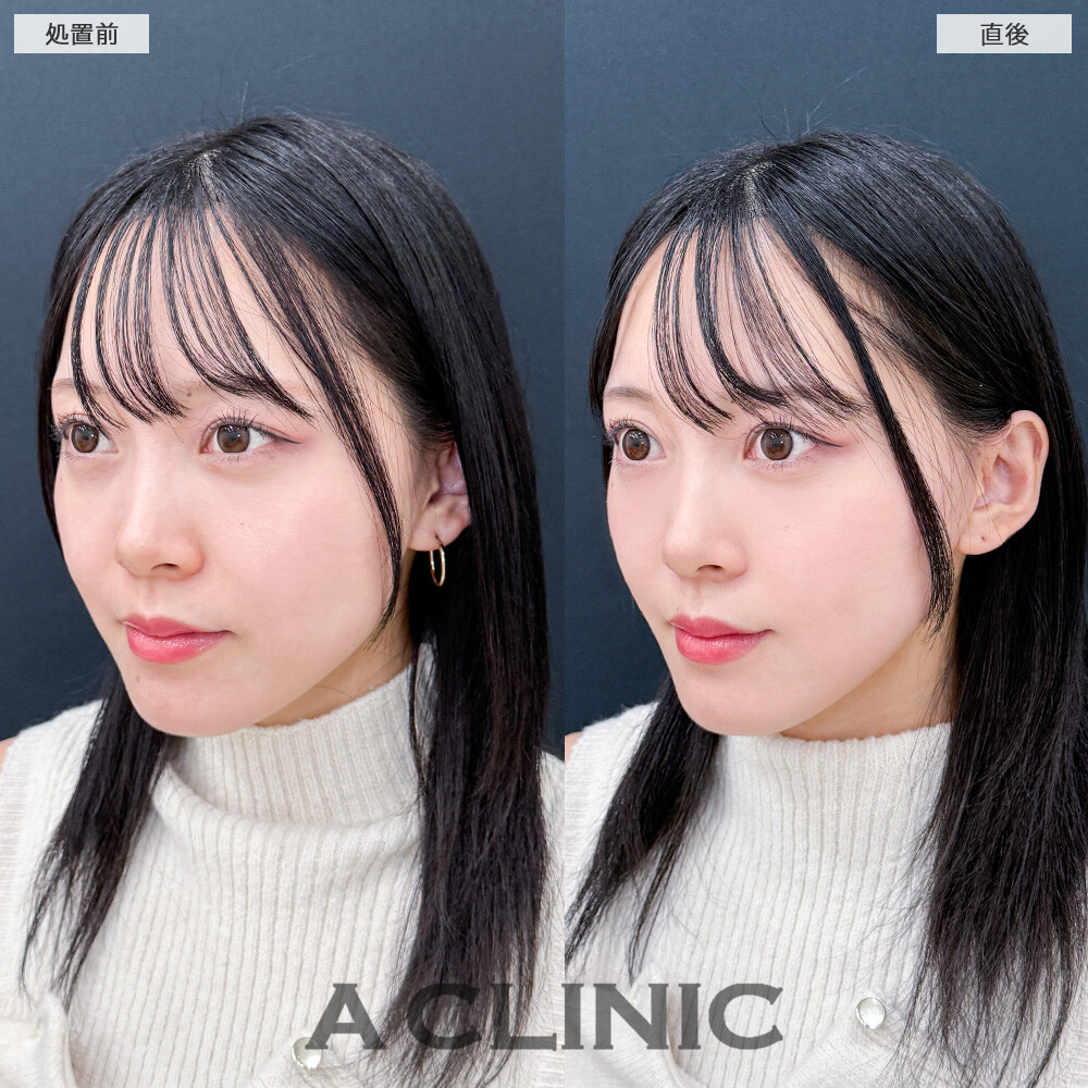 Aスレッドで膨らみのあった輪郭が滑らかになりました！こちら処置前と直後の症例です(20代女性)