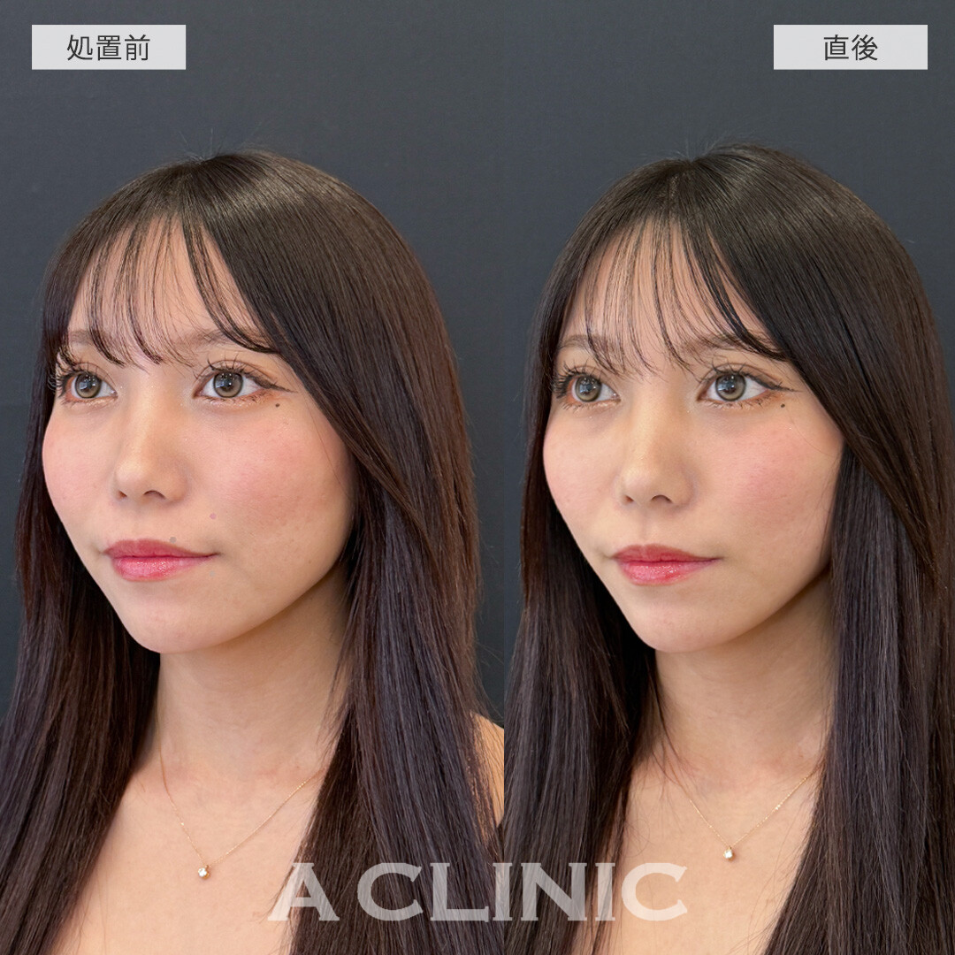 Aスレッドでもたつきを解消して直後からシュッとした輪郭に！こちら処置前と直後の症例です(20代女性)