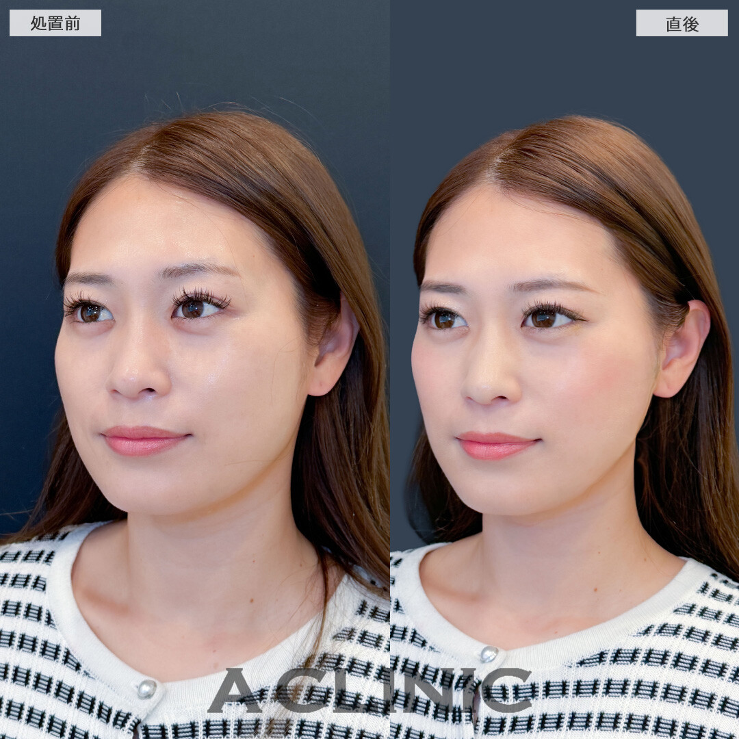 Aスレッドでナチュラルにフェイスラインのもたつきを解消！こちら処置前と直後の症例です(30代女性)