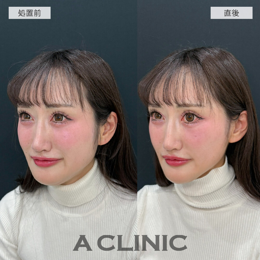 Aスレッドでたるみを解消して中顔面短縮！こちら処置前と直後の症例です(30代女性)