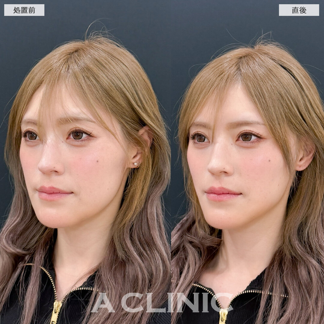 Aスレッドで手軽に理想のVフェイスを手に入れられます！こちら処置前と直後の症例です(30代女性)