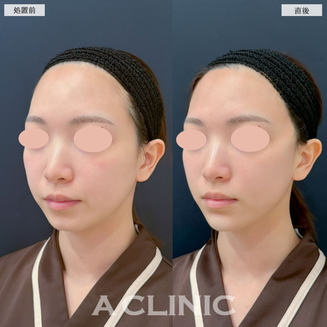 Aスレッドとあごへのヒアルロン酸注入で綺麗な卵型の輪郭になりました！こちら処置前と直後の症例です(30代女性)
