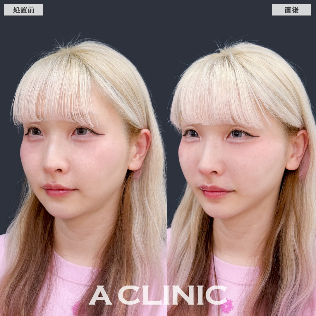 Aスレッドでフェイスラインを整えリフトアップすることで若返って見えます！こちら処置前と直後の症例です(30代女性)
