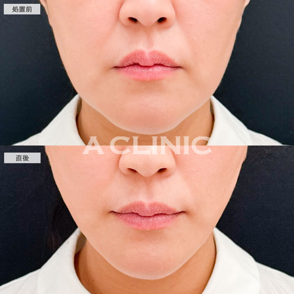 Aスレッドでフェイスライン全体のたるみが改善！こちら処置前と直後の症例です(40代女性)