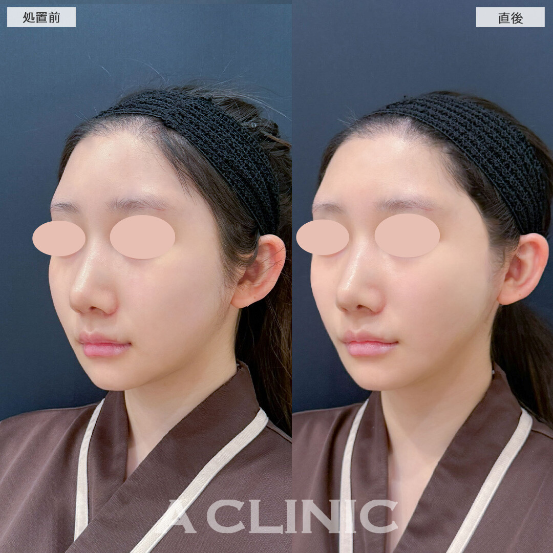 Aスレッドはダウンタイム最小限にしっかりフェイスラインを引き上げられます！こちら処置前と直後の症例です(10代女性)