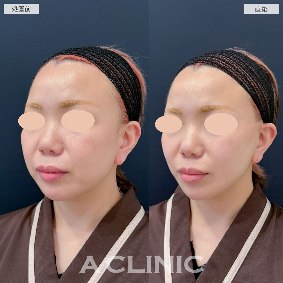 Aスレッドで口横のたるみがしっかり引きあがり若々しい印象になりました！こちら処置前と直後の症例です(40代女性)