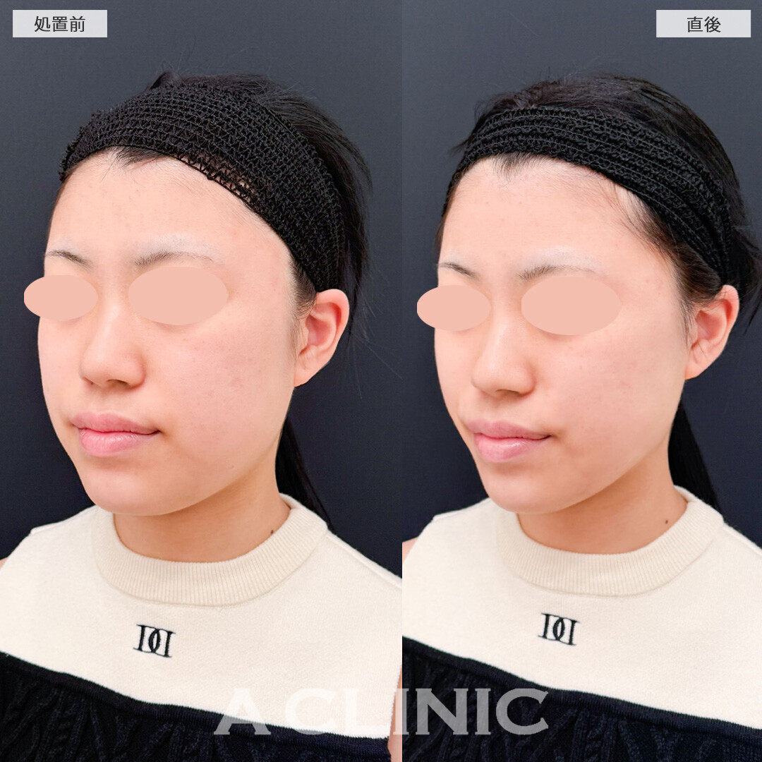 Aスレッドでスリムな印象の輪郭に！こちら処置前と直後の症例です(20代女性)