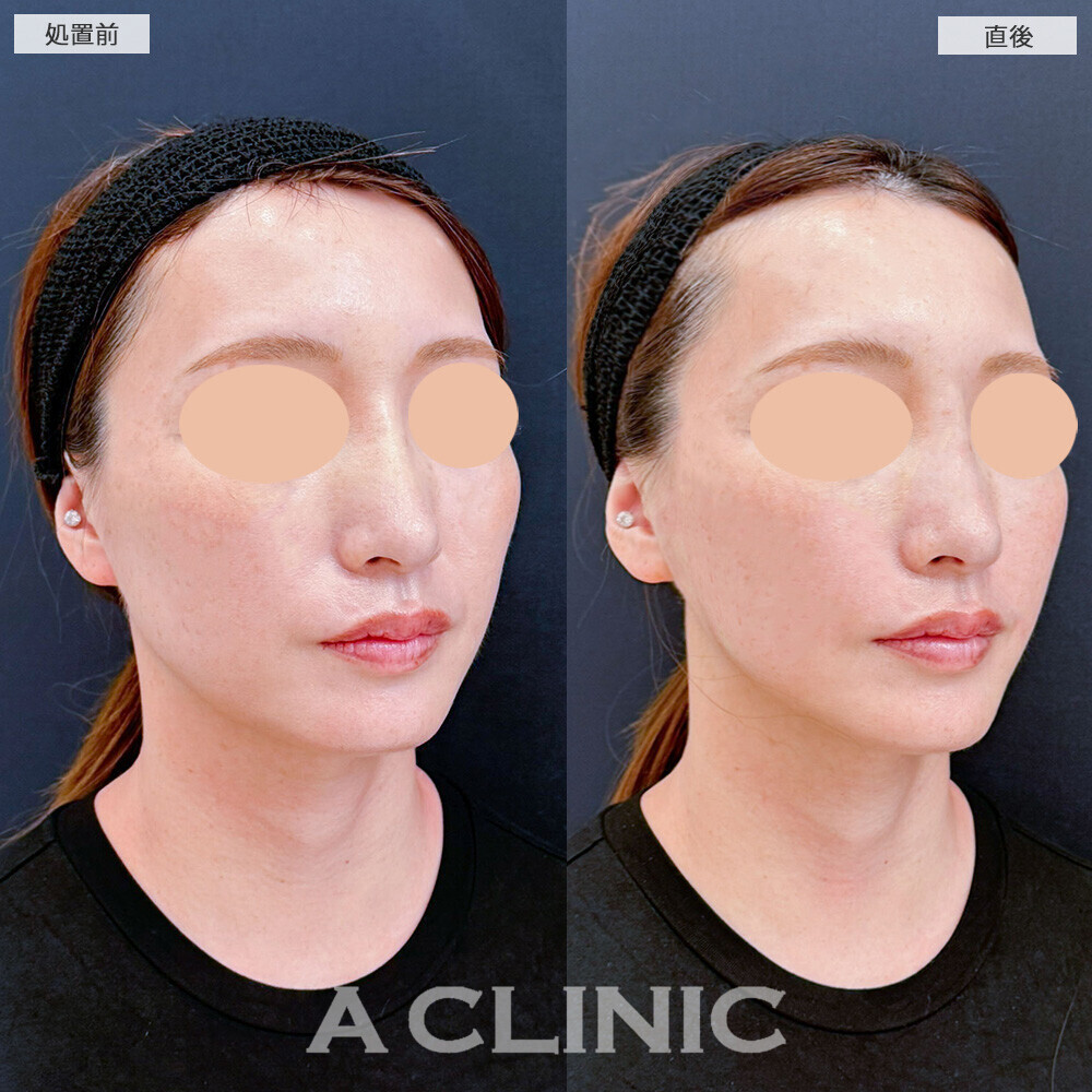 Aスレッドとヒアルロン酸注射(シワ)で若返りました！こちら処置前と直後の症例です(40代女性)