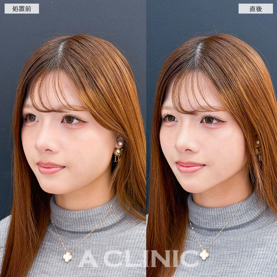Aスレッドなら即日憧れのVフェイスに！こちら処置前と直後の症例です(10代女性)